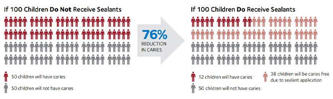 Sealants can help reduce the prevalence of cavities by up to 80%. 