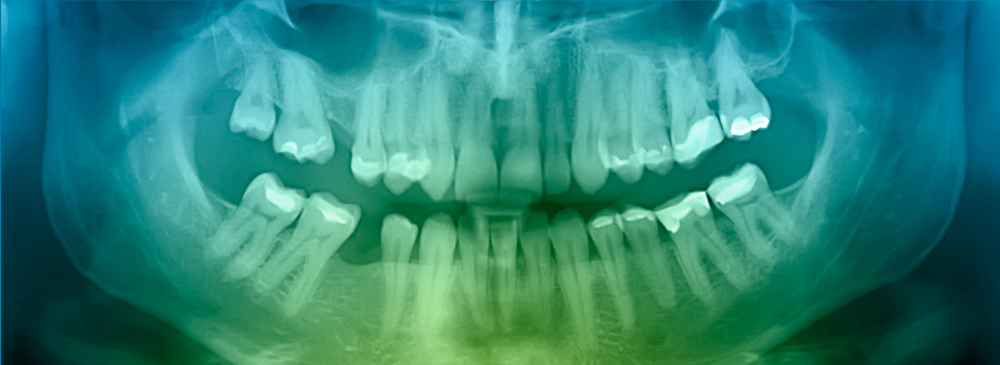 what color are cavities